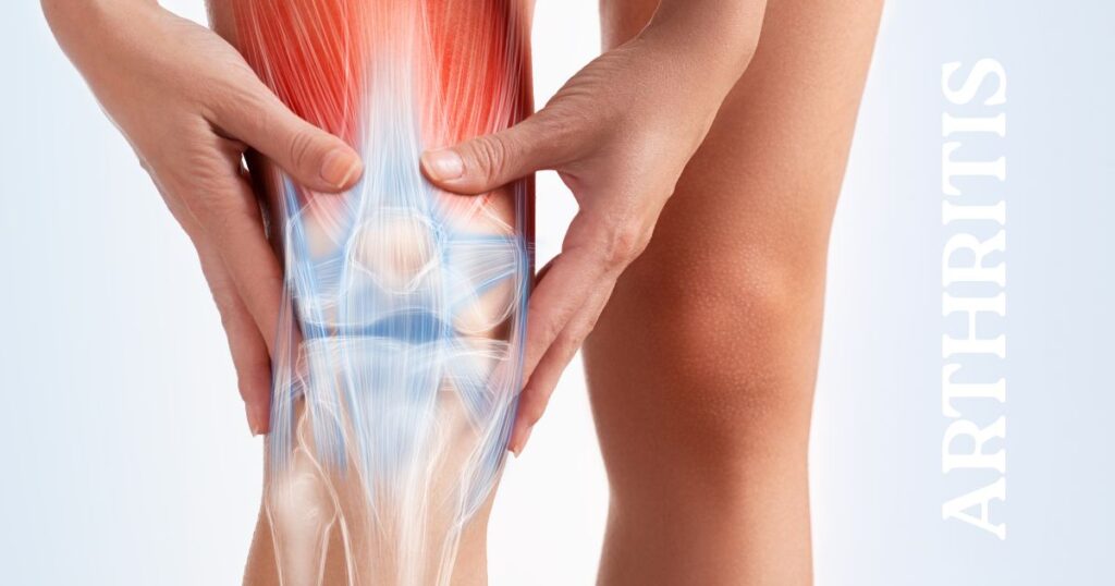 Arthritis